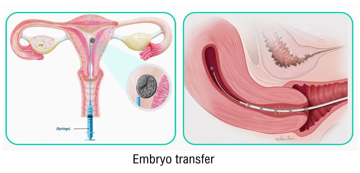 การย้ายตัวอ่อนเข้าสู่โพรงมดลูก (Embryo transfer)