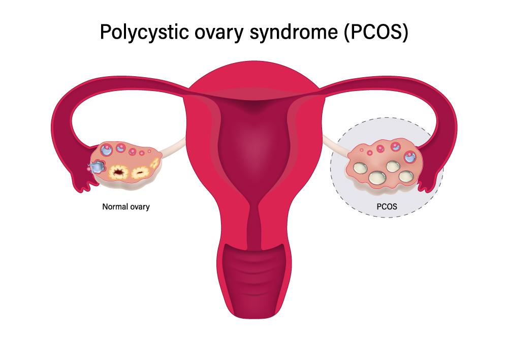 รู้หรือไม่ ผู้หญิงอ้วน น้ำหนักตัวเกิน เสี่ยงถุงน้ำรังไข่หลายใบ (PCOS ...