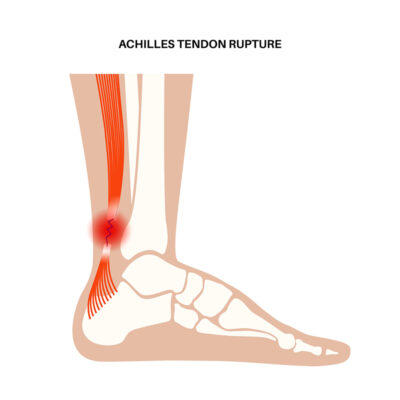 เอ็นร้อยหวายอักเสบ (Achilles Tendinosis)